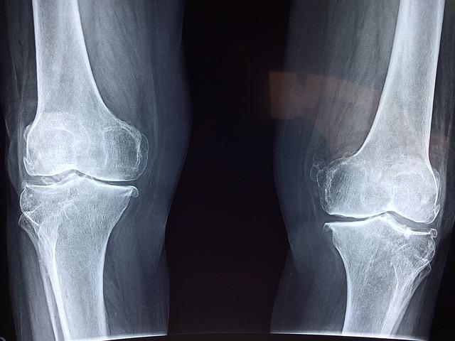Co jsou to nemoci kolene a jak je poznat