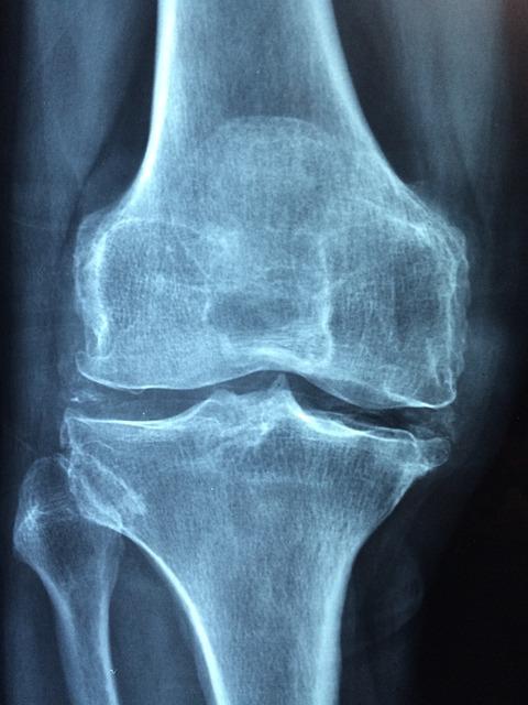 Jak předcházet a zpomalovat vývoj artrózy kolene